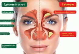Ринит и синусит отличия симптомов и лечение болезней