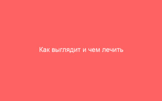 Как выглядит и чем лечить вульвовагинит у женщин