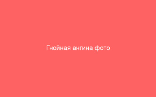 Гнойная ангина фото признаки симптомы и лечение горла у взрослых.1